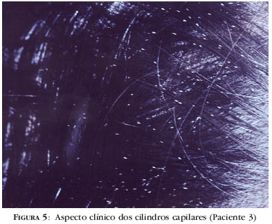 Tricorrexis Nodosa Tricorrexis Nodosa